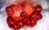 Endometriale Hyperplasie (2)